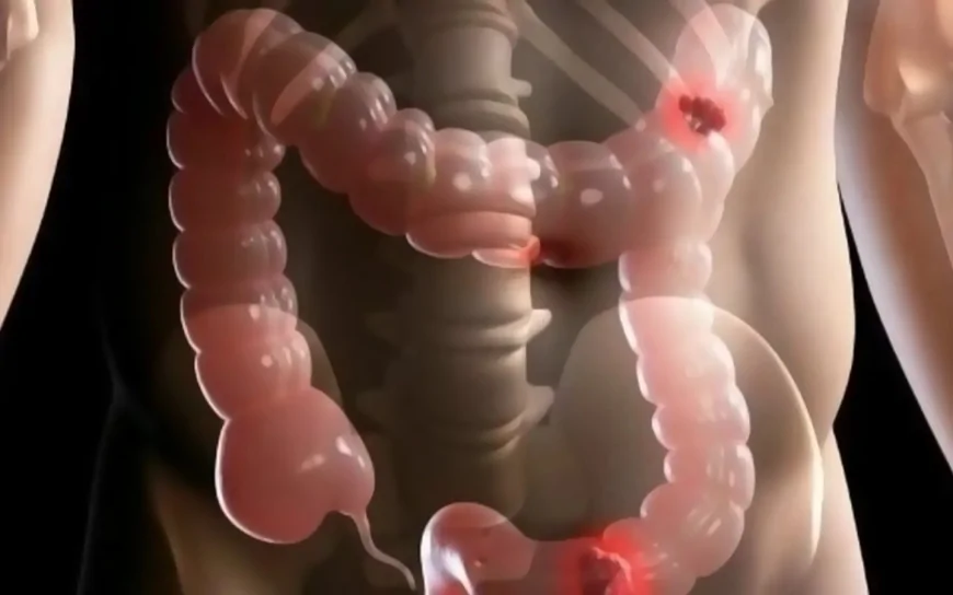 Sadece 24 Yaşındaydı Ve Doktorlar Bile İnanamadı! Tuvalette Gördüğü Kan Hayatını Kurtardı